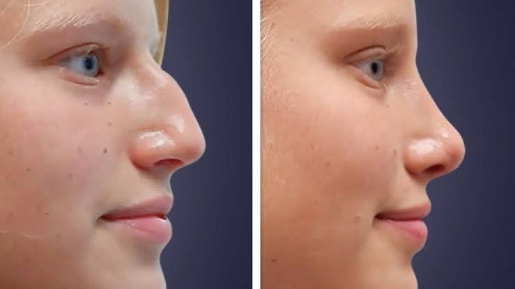 Rhinoplasty Consultation and Facial Architecture Analysis