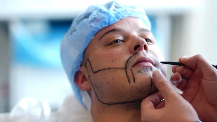 Mustache Hair Transplantation