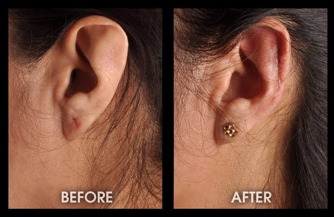 Ear Sculpting Surgery Consultation
