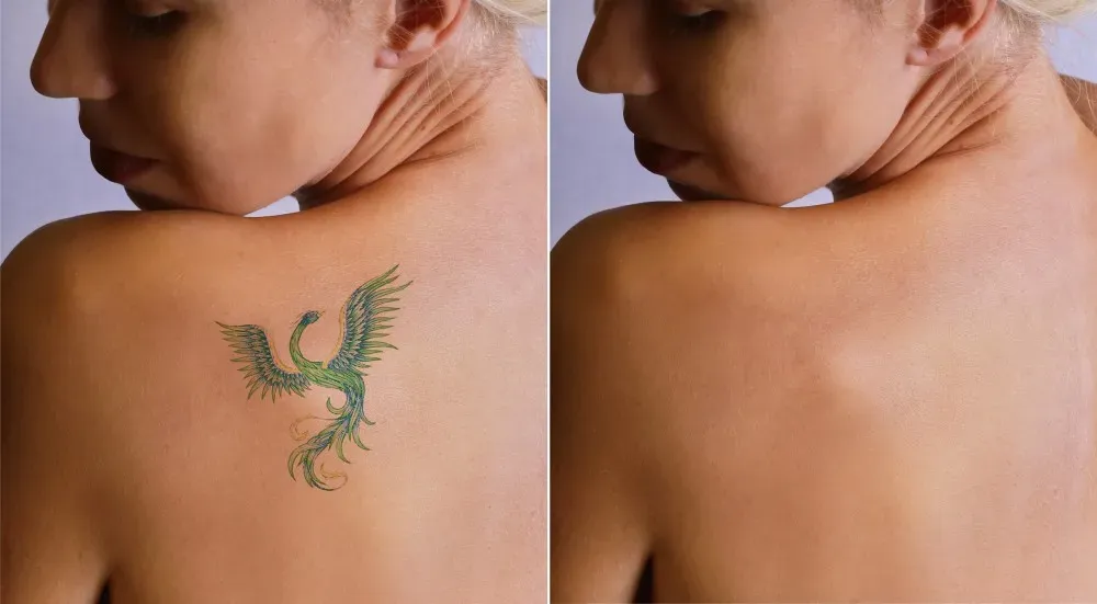Laser Tattoo Removal Treatment